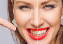 Różne metody wybielania zębów